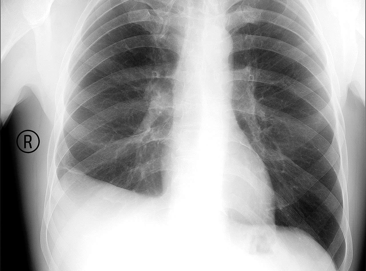 Пузырек воздуха в легком. Туберкулезный плеврит рентген. Плеврит рентген снимка. Костальный плеврит рентген. Плеврит на рентгене легких.