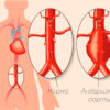 симптомы аневризмы аорты