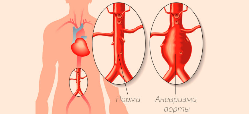 симптомы аневризмы аорты