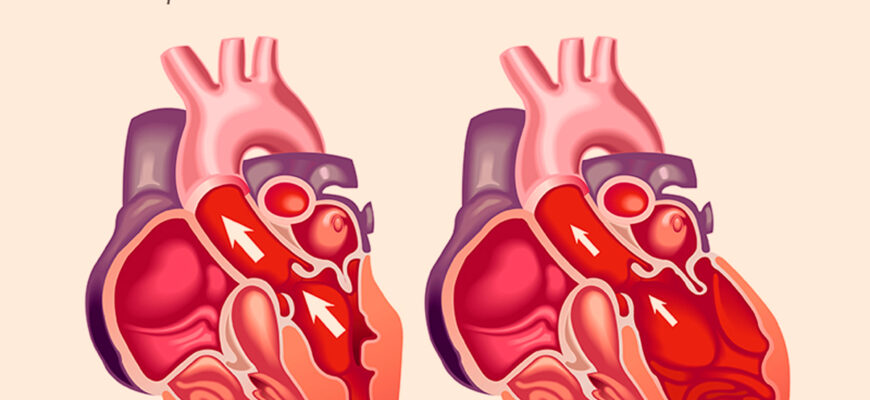 кардиомиопатии сердца