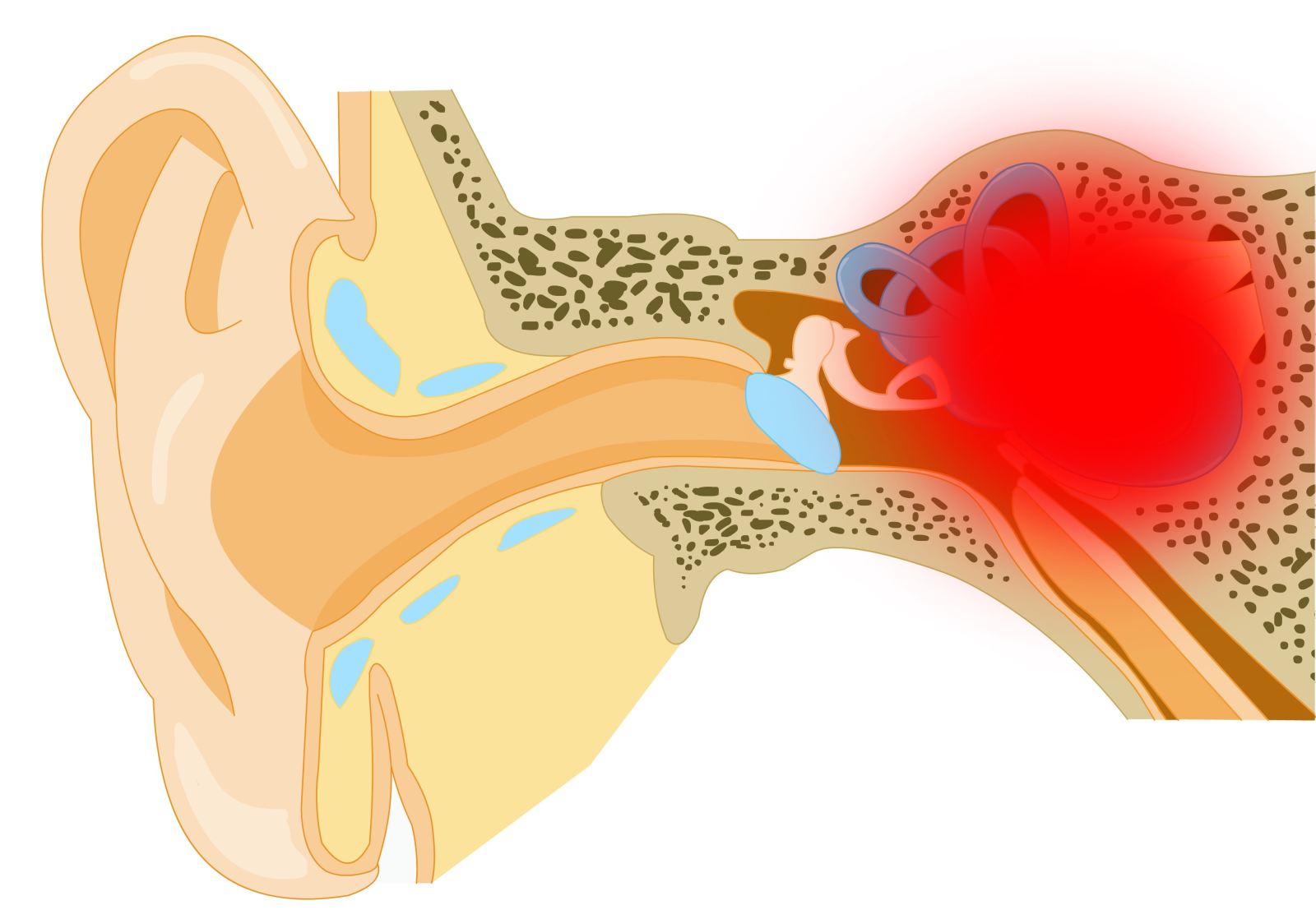 Причины воспаления среднего уха. Менингогенный лабиринтит. Травматический лабиринтит. Внутренний отит (лабиринтит). Тимпаногенный лабиринтит.